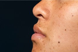 glutathione treatment in bangalore 